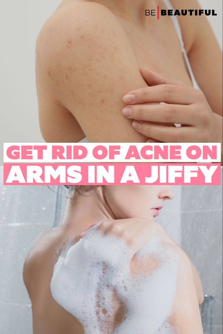 Remedies for acne on the arms Get Rid Of Arm Acne, Acne On Arms How To Get Rid Of, How To Get Rid Of Arm Acne, How To Get Rid Of Shoulder Acne, How To Get Rid Of Bumps On Arms, Acne On Arms, Arm Pimples, Arm Acne, Leg Acne