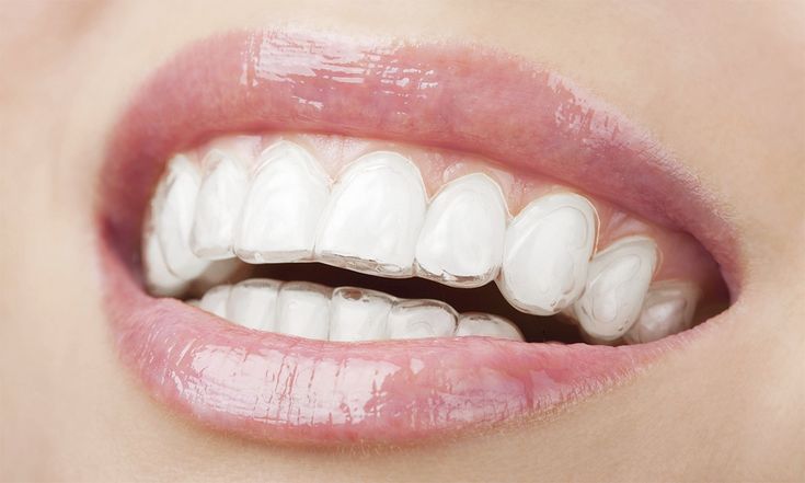 Deep Teeth Cleaning, All On 4 Dental Implants, Nails Ideas Valentines Day, February Nails Ideas Valentines Day, Invisible Aligners, February Nails Ideas, Girls With Braces, Invisalign Braces, Dental Spa