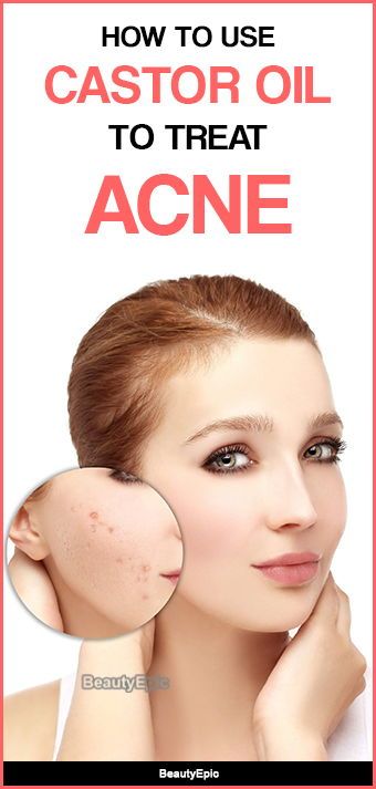 Castor Oil for Acne Castor Oil For Acne, Coconut Oil For Acne, Natural Acne Remedies, Acne Oil, Treat Acne, Fall Makeup Looks, Acne Remedies, How To Get Rid Of Acne, How To Treat Acne