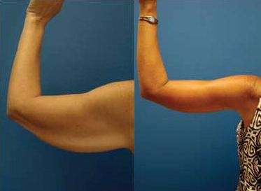 Arm Liposuction at HarleyBodyClinic in London Vaser Lipo, Lipo Before And After, Body Contouring Surgery, Lasik Eye Surgery, Body Makeover, The Plastics, Los Angeles Hollywood, Arm Exercises, The Ledge