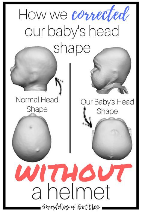 a poster with the words, how we corrected our baby's head shape without a helmet