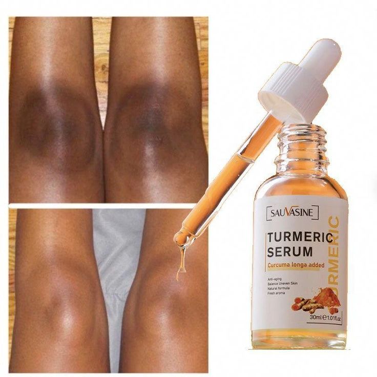 Glow up with healthy turmeric!Skin food that'll make you glow!Turmeric contains antioxidants and anti-inflammatory components. These characteristics may provide glow and luster to the skin. Studies have shown turmeric to reduce dark spots on the skin-AKA hyperpigmentation. In fact, one study showed that a turmeric-ex Face Whitening Serum, Dark Spot Corrector Serum, Forehead Acne, Natural Acne Remedies, Brown Spots Removal, Dark Spots On Skin, Dark Spot Corrector, Skin Blemishes, Acne Remedies