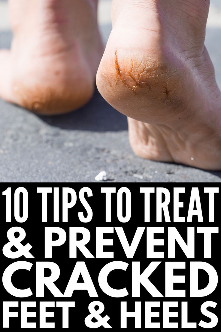 Cracked Feet Remedies, Homemade Foot Cream, Dry Feet Remedies, Cracked Heel Remedies, Homemade Foot Soaks, Dry Cracked Heels, Fitness Hacks, Cracked Heel, Natural Healing Remedies