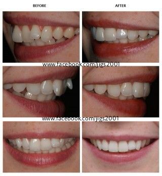 Teeth Alignment & Smile Correction Teeth Alignment, Nice Teeth, Best Teeth Whitening, Natural Teeth Whitening, Natural Teeth, Dental Health, Teeth Whitening, Natural Health, Collage