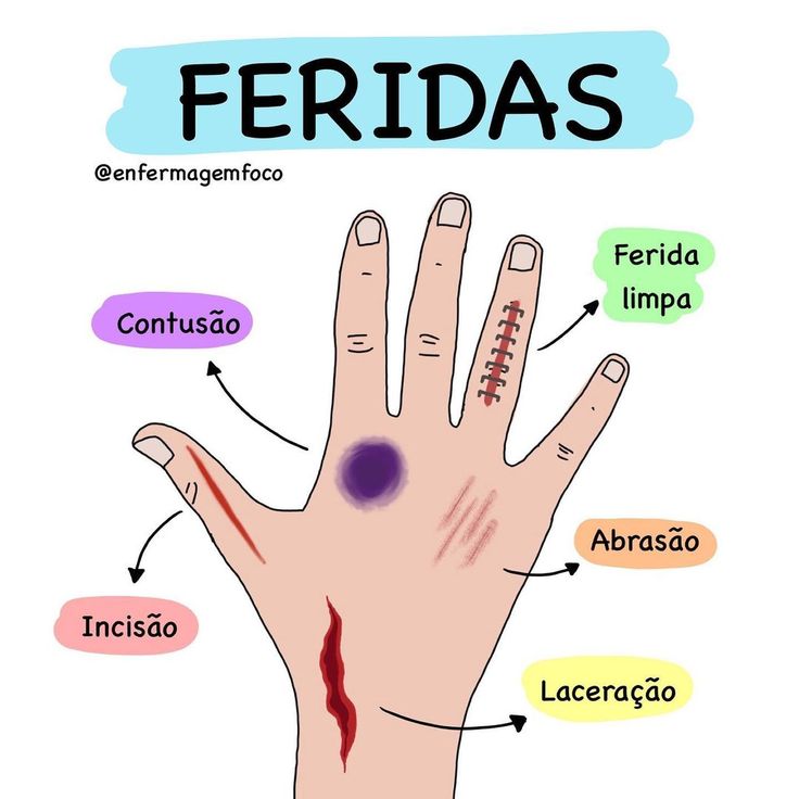 a hand with the word ferids written on it and labeled in different languages