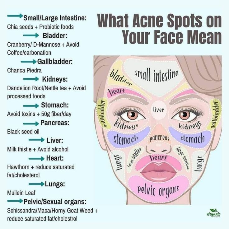 Food For Acne, Face Mapping, Home Doctor, Large Intestine, Acne Spots, Skin Disorders, Improve Health, Health Facts, Health And Beauty Tips