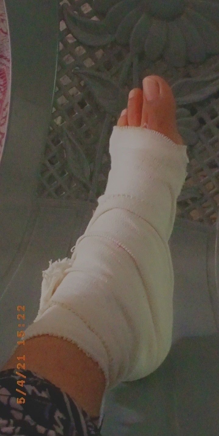 a person with a cast on their arm