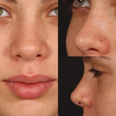 Nose Plastic Surgery, Nose Problems, Nose Surgery Rhinoplasty, Rhinoplasty Nose Jobs, Nose Reshaping, Face Surgery, Rhinoplasty Surgery, Pretty Nose, Perfect Nose