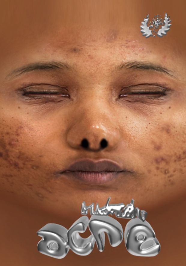 a woman with acne on her face