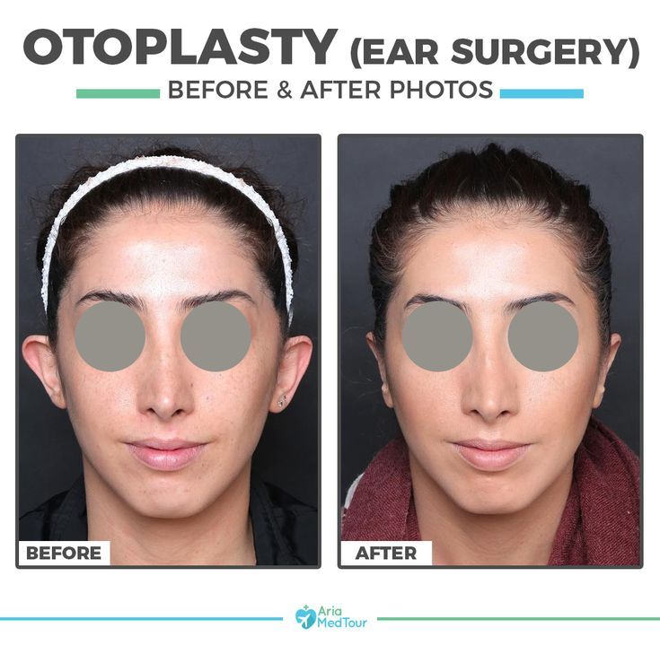 a young lady's face before and after her ear surgery Ear Surgery, Photos Of People, Before After Photo, After Photos, Your Opinion, Dream Body, Plastic Surgery, View Photos, Iran