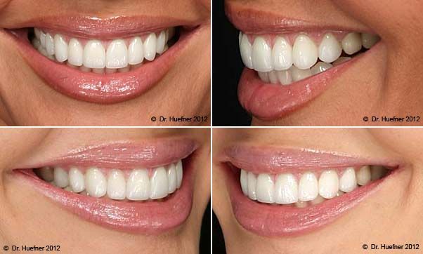 Teeth #Whitening #Greenville is a corrective dental methodology so it is proposed to enhance your grin. Natural Teeth Whitening Remedies, Teeth Images, Pretty Teeth, Teeth Alignment, Veneers Teeth, Teeth Whitening Remedies, Beautiful Teeth, Charcoal Teeth Whitening, Porcelain Veneers