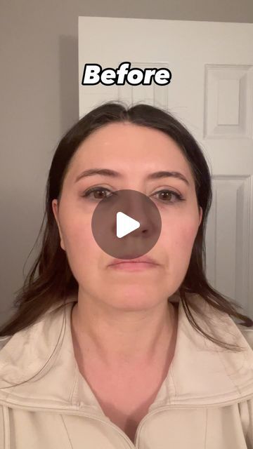 6 likes, 2 comments - dr.jessicaburgy on March 27, 2024: "My before and after photos from laser resurfacing! 💫 I love the results and plan on doing this once a year to keep my skin glowing....". Laser Skin Resurfacing, Laser Resurfacing, Skin Resurfacing, Skin Glowing, Laser Therapy, March 27, After Photos, My Skin, A Year