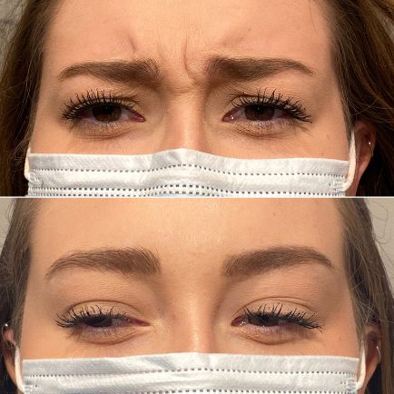 Soften facial lines, forehead lines & wrinkles with natural looking results with Austin Botox injections at Viva Day Spa + Med Spa. Hungover Remedies, Botox Results, Botox Cost, Botox Clinic, Forehead Lines, Botox Before And After, Homemade Face Mask, Botox Cosmetic, Cosmetic Injectables