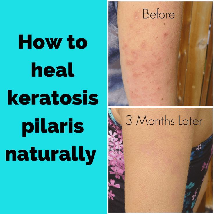 Chicken Skin Remedy, Arm Acne, Keratosis Pilaris Remedy, I Healed, Strawberry Legs, Skin Bumps, Facial Products, Keratosis Pilaris, Bumpy Skin