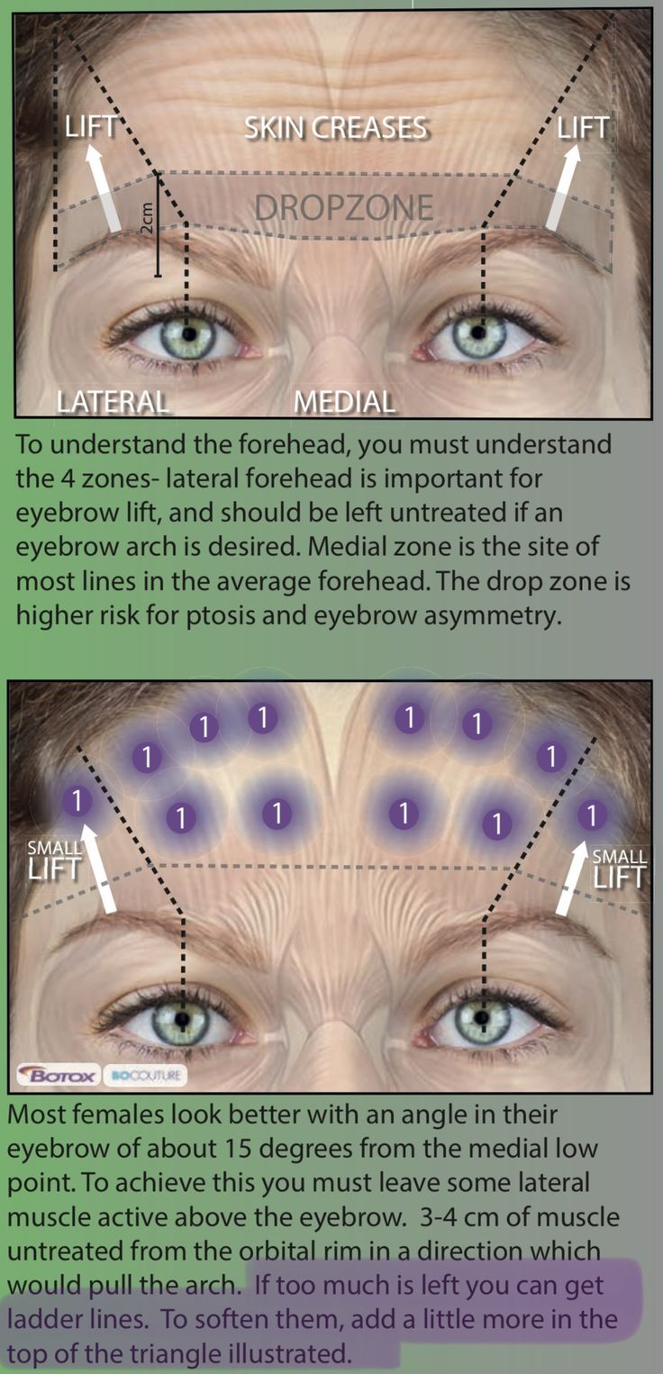 Botox Face Mapping, Botox Trapezius, Botox Placement Chart, Botox Injection Patterns, Nurse Injector Room, Botox Placement, Dysport Injection Sites, Botox Mapping, Botox Eyebrow Lift