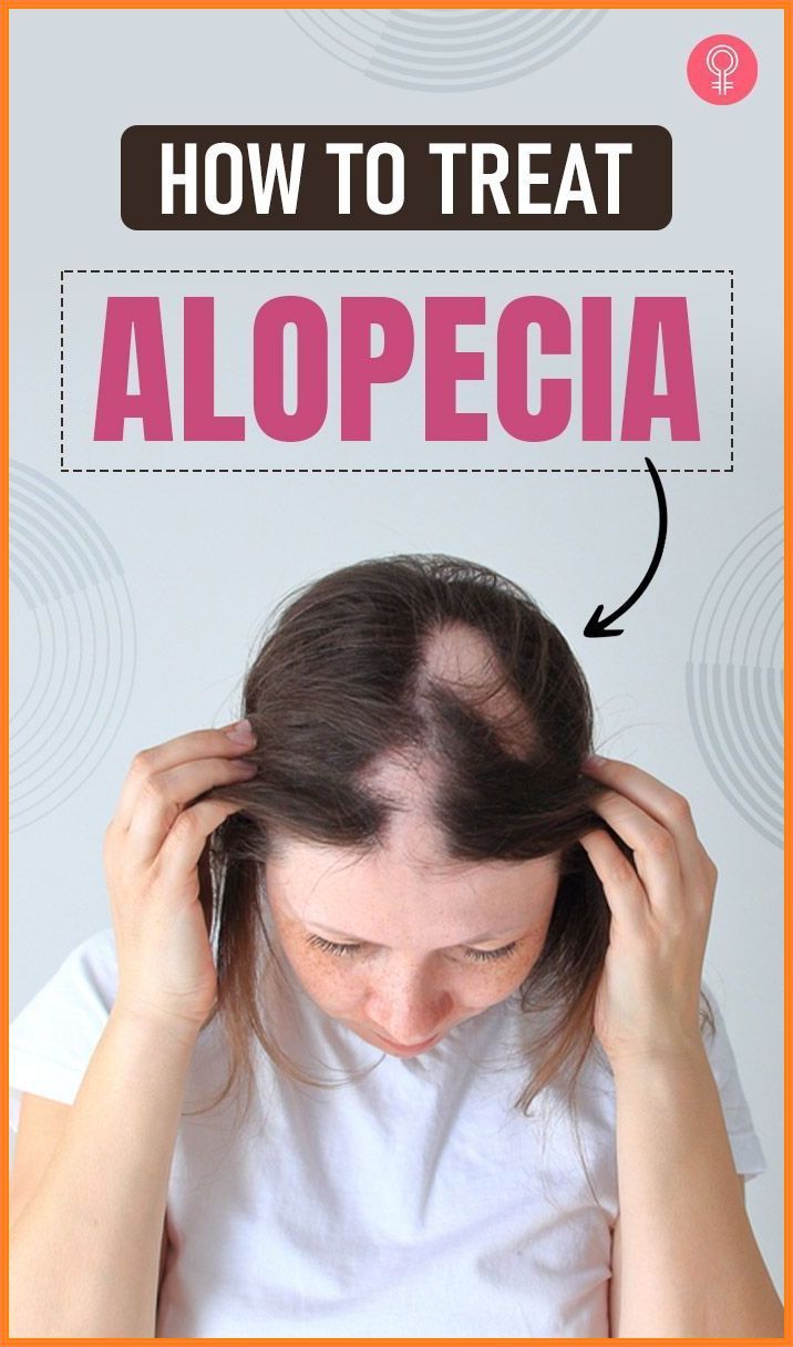 Bonus Tip: Avoid heat styling tools to prevent hair damage. #hairlossprevention #hair #hairfall Traction Alopecia Regrowth, Androgenic Alopecia In Women, Alopecia Hair Growth, Alopecia Hairstyles, Traction Alopecia, Coconut Oil For Hair, Androgenetic Alopecia, Thicker Fuller Hair, New Hair Growth