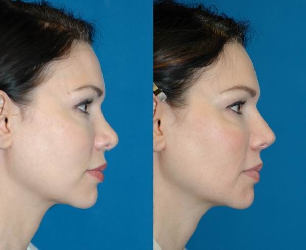 Revision Rhinoplasty Before After, Revision Rhinoplasty, Rhinoplasty Before And After, Neck Surgery, Facial Plastic, Plastic Surgeon, Plastic Surgery, Surgery, Seattle