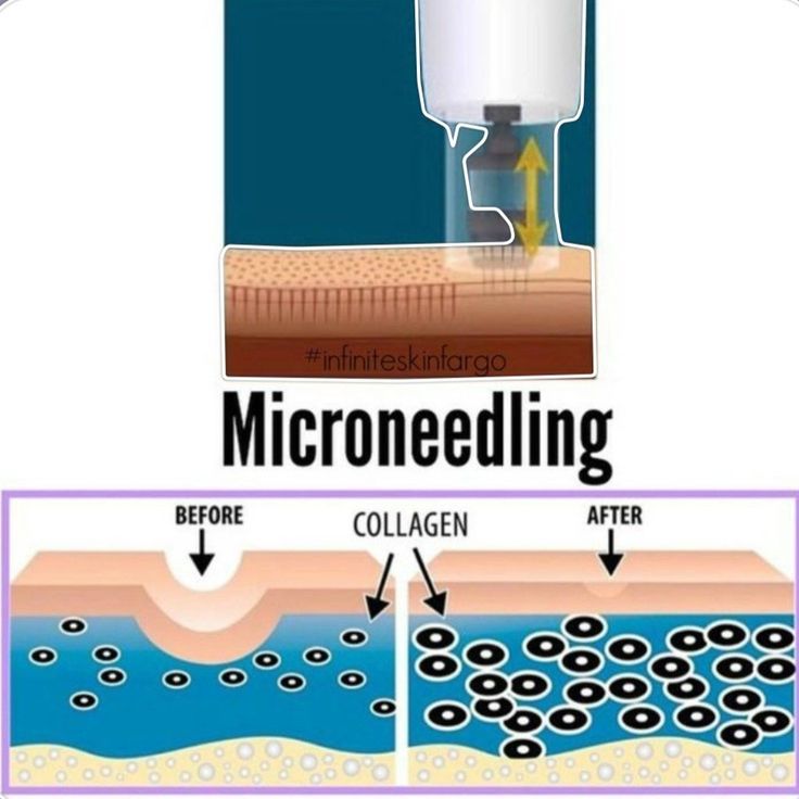 Microneedling Skinpen, Microneedling Before And After, Skinpen Microneedling, Benefits Of Microneedling, Dermapen Microneedling, Skin Care Diy, Skin Anatomy, Skin Needling, Skin Care Pictures