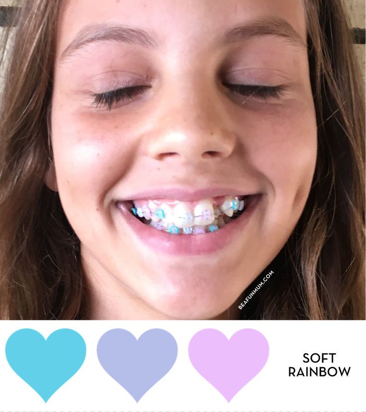 Clarity™ ADVANCED Ceramic Braces Ceramic Braces With Colored Bands, Ceramic Braces Color Bands, Braces For Kids, Ceramic Braces, Kids Braces, Getting Braces, Braces Colors, Teeth Braces, Advanced Ceramics