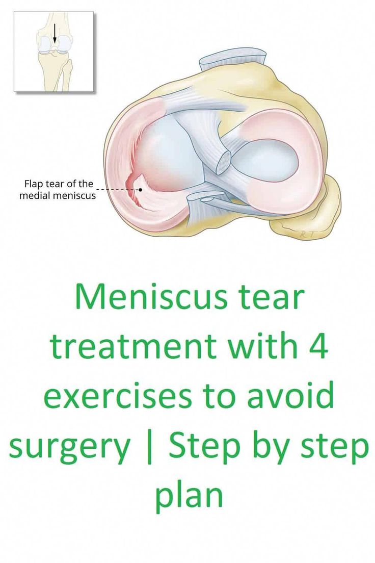 #HerbsForNervePainRelief Meniscus Root Tear Recovery, Torn Medial Meniscus Exercises, Meniscus Surgery Recovery, Meniscus Surgery, Knee Meniscus, Knee Workout, Exercises For Knee Pain, Knee Pain Relief Remedies, Knee Exercise