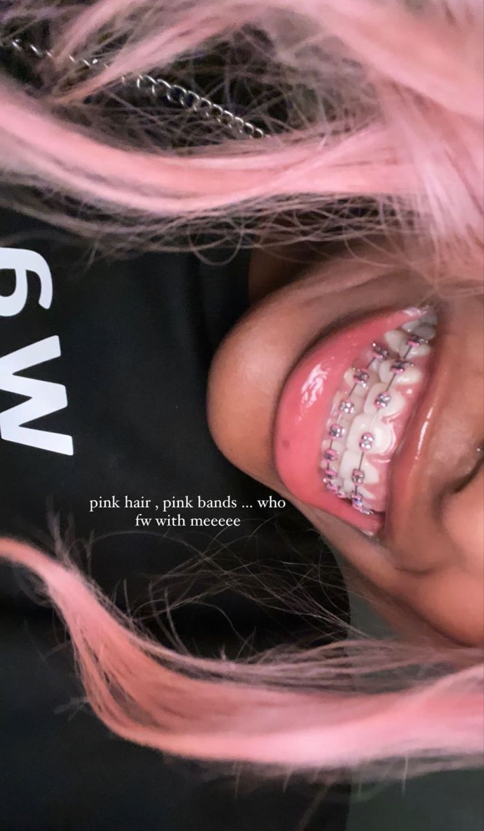 Braces With Lip Gloss, Braces For Black Women, Pink And Black Braces, Pink Braces Black Women, Smiley Piercing With Braces, Pink Braces Aesthetic, Light Pink Braces, Braces Black Women, Pretty Braces