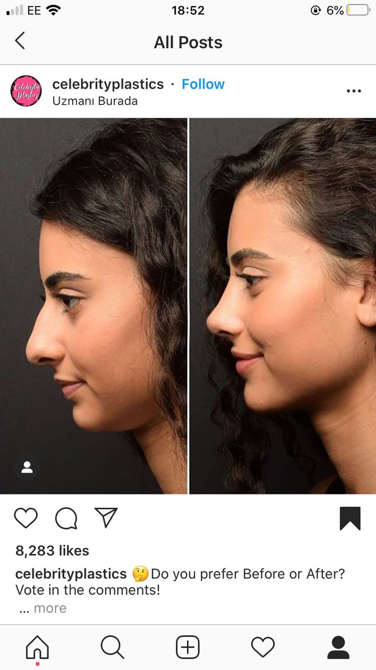 Rhinoplasty Droopy Tip, Saddle Nose Deformity, Natural Nose Job Before After, Perfect Nose Rhinoplasty, Nose Job Inspiration Natural, Best Nose Jobs, Bulbous Nose Rhinoplasty Before After, Rhinoplasty Before After, No Jawline