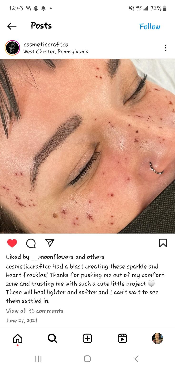 a person with acne on their face and the caption above it says,