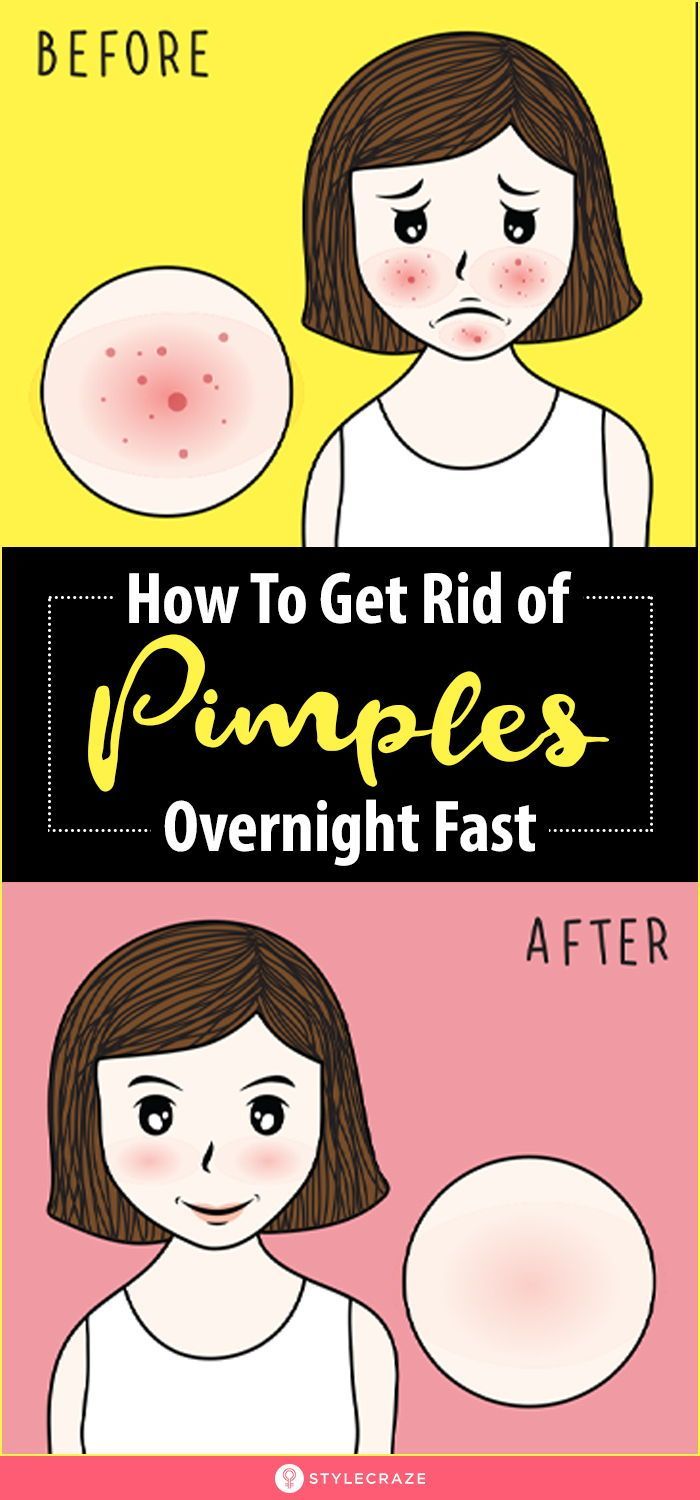 Remove Pimples Overnight, Natural Remedies For Pimples, Get Rid Of Pimples Overnight, Rid Of Pimples Overnight, Back Acne Remedies, Blind Pimple, Pimples Under The Skin, Get Rid Of Pimples, Rid Of Pimples