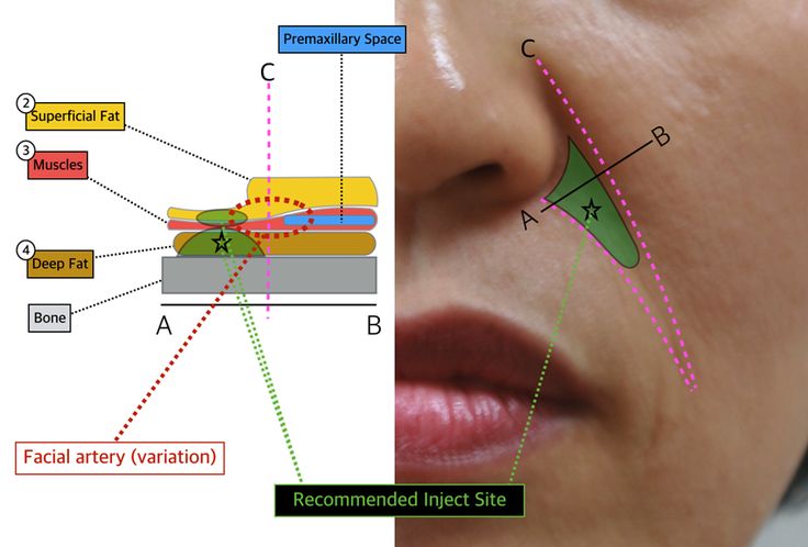 #4-3. Mid Face: Nasolabial fold | D&PS Filler Injection, Facial Injections, Face Fillers, Aesthetic Dermatology, Facial Anatomy, Skin Facts, Face Anatomy, Facial Fillers, Diy Beauty Treatments