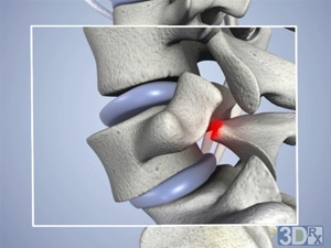 Spondylolisthesis - bone at red mark breaks and lower vertebrae shifts forward and out of alignment with vertebrae above and below, pinching the spinal nerve. Hip Health, Osteopathic Medicine, Spine Care, Cervical Spondylosis, Spinal Fusion, Arthritic Pain, Disk Herniation, Spinal Nerve, Spine Health