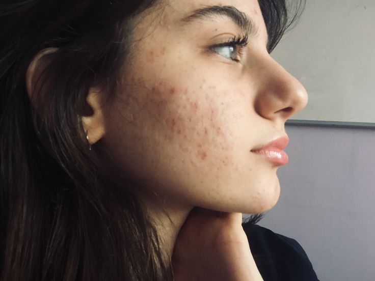 Acne Appreciation, Acne Positive, Girl With Acne, Acne Positivity, Skin Positivity, Lemon Face Mask, Home Remedies For Pimples, Pimples Overnight, Scaly Skin