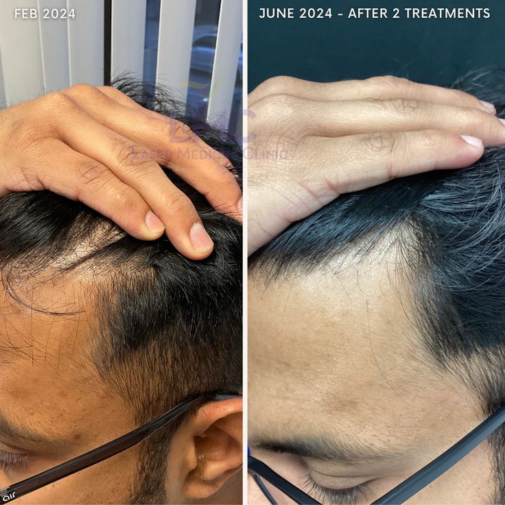 In just 4 months and 2 treatments, this patient has achieved noticeable hair regrowth, with a fuller hairline and improved hair density that’s hard to miss. 🌱

💡 What is PRP Hair Restoration?
Platelet-Rich Plasma (PRP) therapy harnesses the regenerative power of your body’s own platelets. By using growth factors found in your blood, PRP stimulates dormant hair follicles, revitalizes the scalp, and promotes natural, long-lasting hair regrowth. Double Chin Reduction, Permanent Laser Hair Removal, Prp Therapy, Prp Hair, Hair Transplant Procedure, Androgenetic Alopecia, Skin Resurfacing, Unique Hair, Hair Follicles