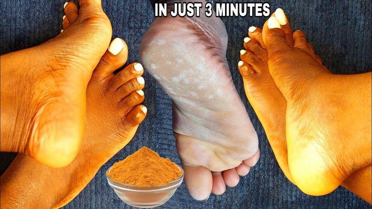 hi guys welcome back to my channel today's video I will be showing you how to soften your feet in 10 minutes  at home  get rid of dryheel how to remove dead ... Diy Cracked Heel Remedy, Feet Soak, Pedicure Diy, Cracked Heel Remedies, Healthy Book, Diy Pedicure, Welcome Back To My Channel, Home 2023, Cracked Heels