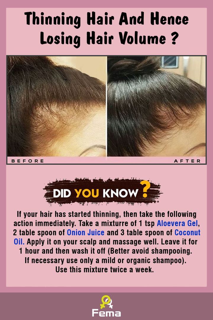 Silky Hair Remedies, Onion Juice For Hair, Thining Hair, Diy Hair Oil, Thinning Hair Remedies, Losing Hair, Hair Growth Challenge, Hair Growth Foods, Natural Face Skin Care