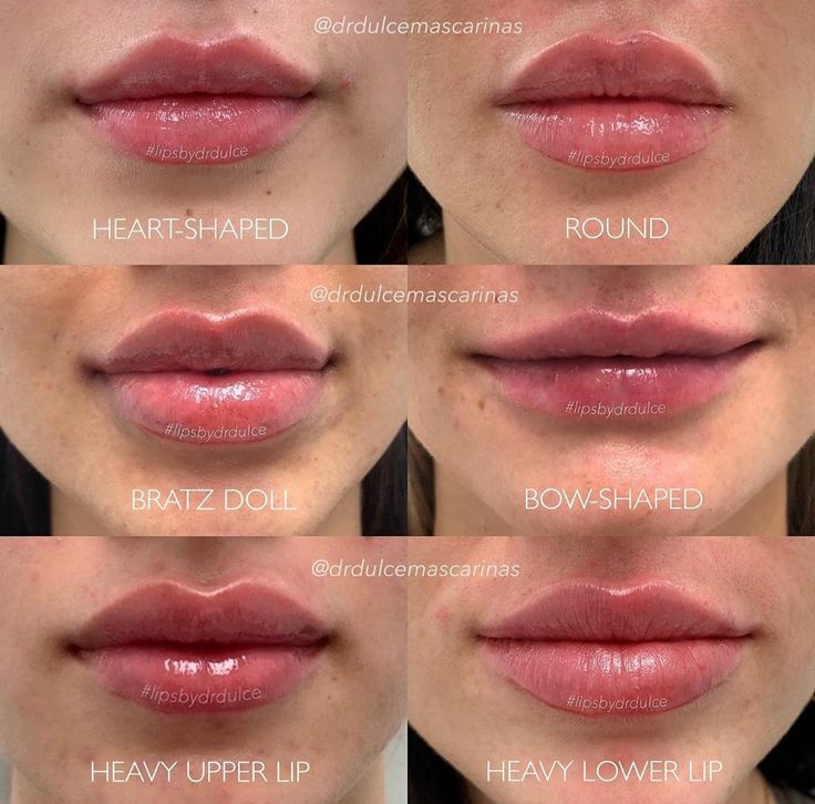 Gaun Koktail, Lips Inspiration, Face Fillers, Botox Lips, Being Unique, Facial Fillers, Facial Aesthetics, Botox Fillers, Makijaż Smokey Eye