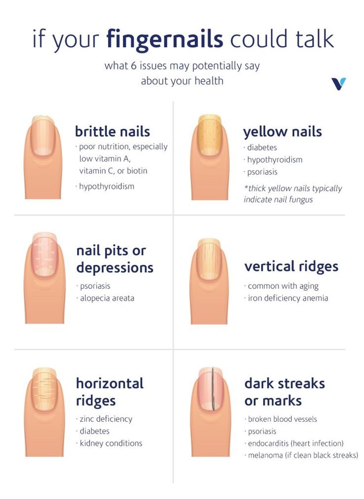 Fingernail Health, Calendula Benefits, Matcha Benefits, Lemon Benefits, Poor Nutrition, Coconut Health Benefits, Stomach Ulcers, Brittle Nails, Benefits Of Coconut Oil