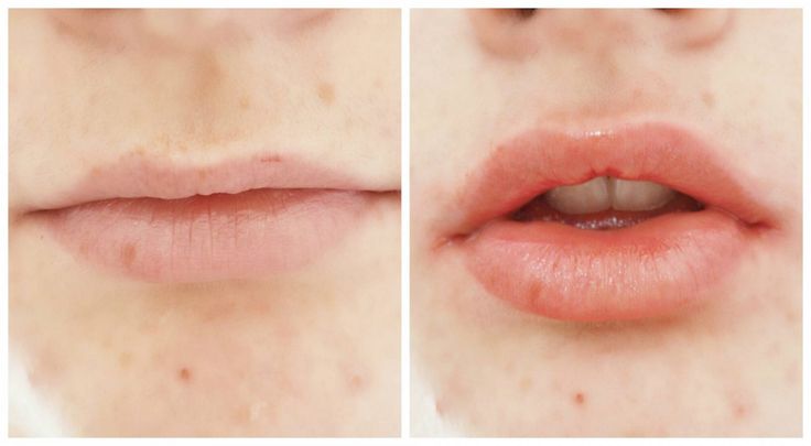 SkinXL lip plumper before and after review Large Lips, Lip Art Makeup, Best Lip Gloss, Homemade Lip Balm, Oil Free Makeup, Dry Skin Patches, Lipstick Art, Lots Of Makeup, Happy Skin