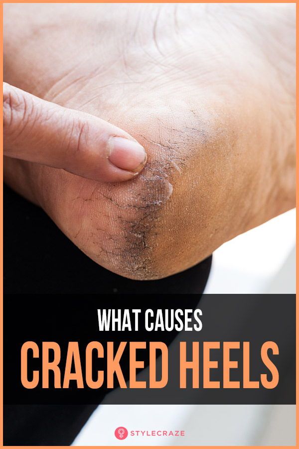 What Causes Cracked Heels? #trending #trends #trendingnow Soften Heels Diy, Soft Heels Remedies, Soft Heels How To Get, Rough Feet Remedy Heels, How To Get Rid Of Cracked Heels, Healing Cracked Heels, How To Heal Cracked Heels, Dry Heels How To Get Rid Of, Heel Cracks Remedies