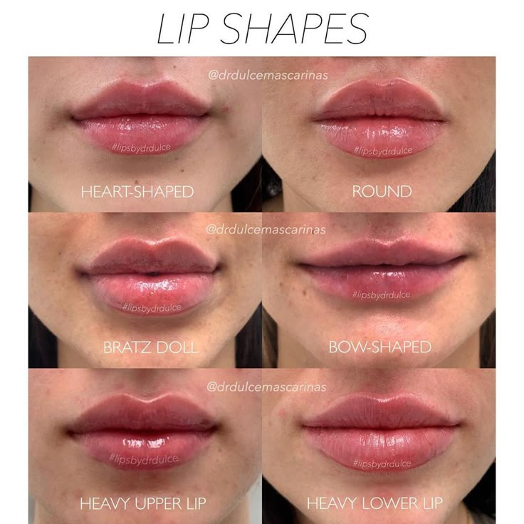 Dermal Fillers Lips, Lip Types, Lips Inspiration, Face Fillers, Facial Contouring, Facial Fillers, Being Unique, Facial Aesthetics, Lip Filler