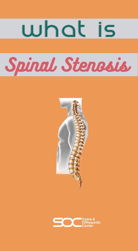 Stenosis Of The Spine, Stenosis Exercises, Spinal Degeneration, Spinal Fusion Surgery, Spinal Fusion, Spinal Decompression, Spinal Surgery, Spinal Nerve, Spine Health