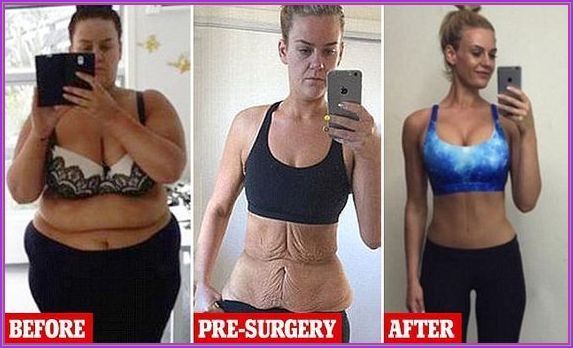 I lost 60 pounds in just 5 months* i used to very healthy an Skin Removal Surgery Before And After, Simone Anderson, Excess Skin, After Photos, Stubborn Belly Fat, Transformation Body, Web Site, Belly Fat, Fat Loss