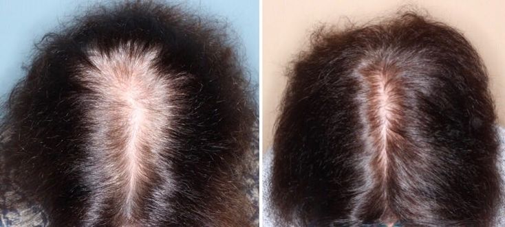 MINOXIDIL ORAL PARA LA ALOPECIA Madrid