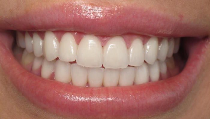 Crush Signs, Teeth Aesthetic, Pretty Teeth, Wish Board, Beautiful Teeth, Porcelain Veneers, Perfect Teeth, Dream Vision Board, Smile Teeth