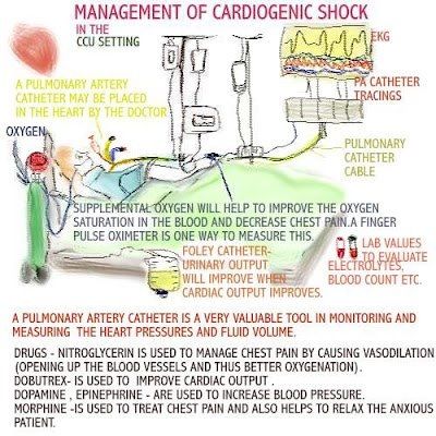 a poster with instructions on how to use the cardiogenic shock machine for heart health