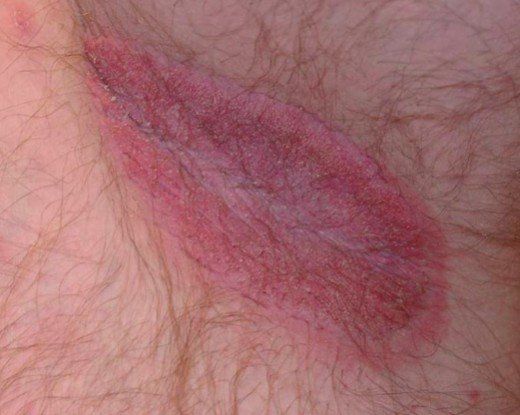 Groin Rash, Home Remedies For Rashes, Yeast Infection On Skin, Home Remedies For Face, Fungal Rash, Armpit Rash, Rashes Remedies, Remove Skin Tags Naturally, Heat Rash