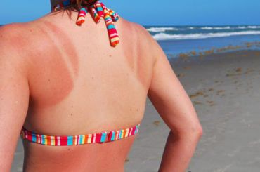 Crepey Skin: Causes and Treatment Options – Cleveland Clinic How To Even Out Tan Lines, How To Get Rid Of Tan Lines, Tanning Lines, Bad Tan Lines, Get Rid Of Tan, Home Remedies For Sunburn, Natural Remedies For Sunburn, Farmers Tan, Sunburn Remedies