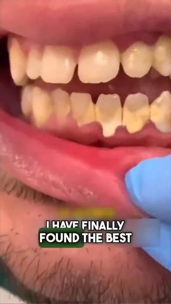 Salt Toothpaste, Natural Teeth Whitening Diy, Home Teeth Whitening, Teeth Whitening Homemade, Whitening Teeth, Teeth Whitening Diy, Diy Skin Care Routine, Teeth Health, Basic Skin Care Routine