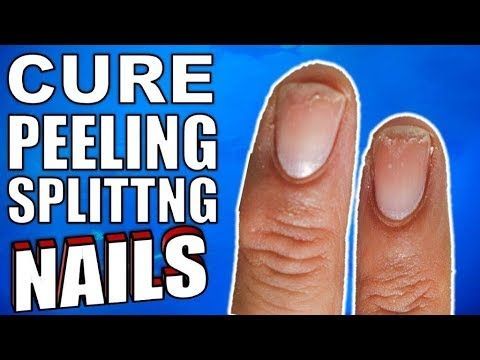 Why Are Your Nails Peeling & Splitting ? |How to Stop It For Good Dealing with weak, brittle, peeling nails is a super frustrating issue. Not only does nail polish chip faster, but it's also super painful when you reach for something and your nails actually bend.  It affects upto 20 percent of the population Some health conditions can result in peeling of both fingernails and toenails, but if only your fingernails are affected, the cause is likely to be external. Finger Nails Health, Peeling Nails Remedy, Peeling Fingernails, Fingernail Health, Healing Guide, Peeling Nails, Hair Falling, Nail Infection, Health Video