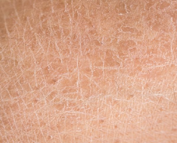 Dealing with Diabetic Skin Care Problems Scale Skin, Scaly Skin, Adrenal Fatigue, Skin Disorders, Skin Remedies, Flaky Skin, Rough Skin, Itchy Skin, Dehydrated Skin