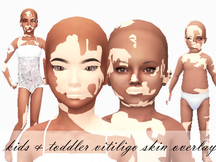 ForeverXXSims_Child&ToddlerVitligo_Merged Sims 4 Cc Vilitigo Skin Infant, Sims 4 Smooth Skin, Sims 4 Cc Toddler Skin Overlay, Sims 4 Cc Kids Body Presets, Sims 4 Cc Child Body Preset, Sims 4 Toddler Skin Details, Sims 4 Vilitigo Cc, Mom Sims 4 Cc, Sims 4 Cc Vilitigo Skin Details